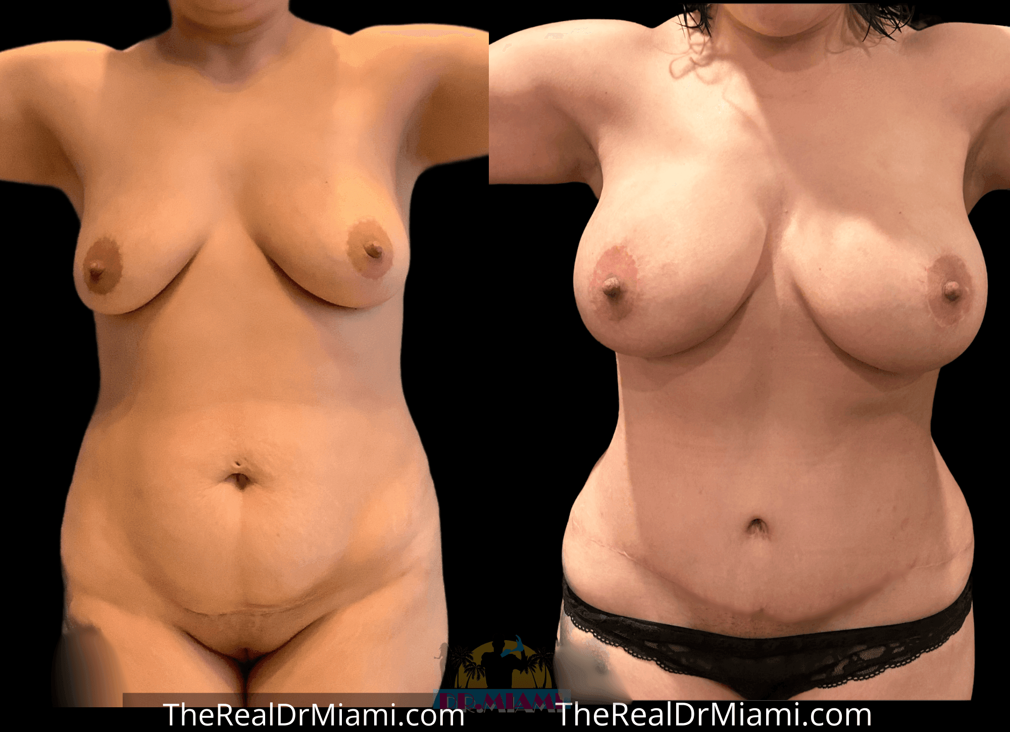Before-and-after views for Mommy Makeover, Case 13.