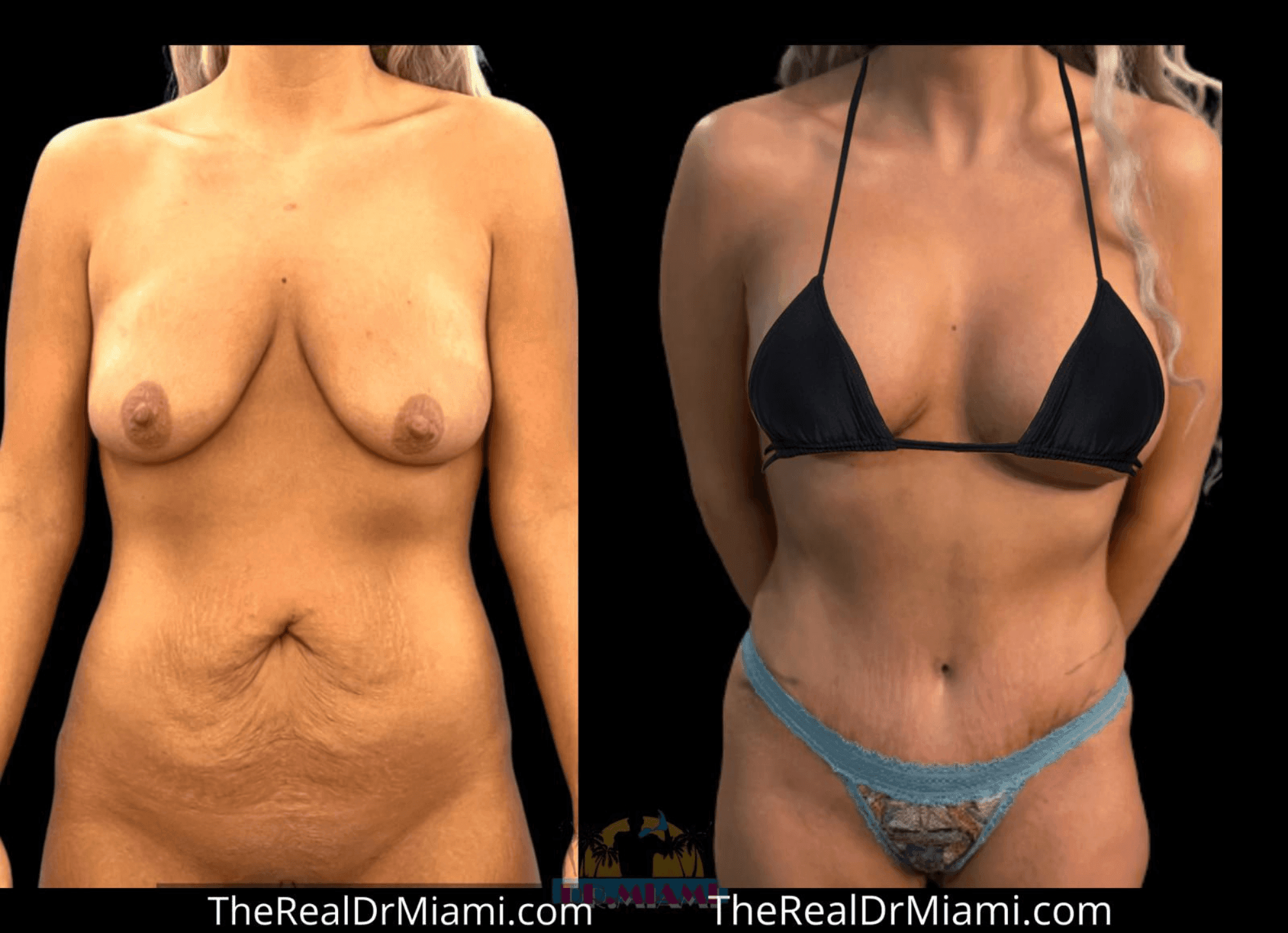 Before-and-after views for Tummy Tuck, Case 13.