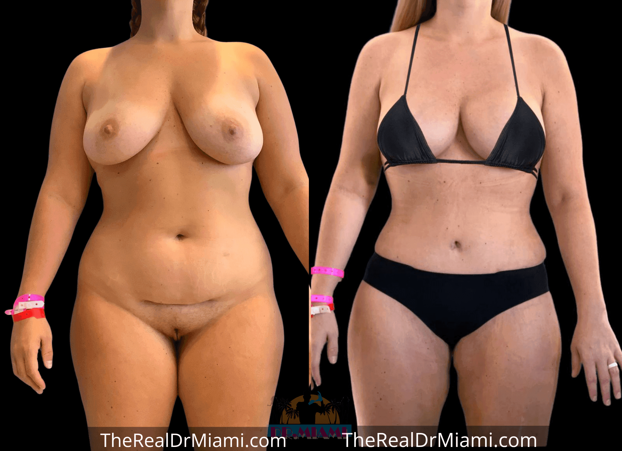 Before-and-after views for Tummy Tuck, Case 50.