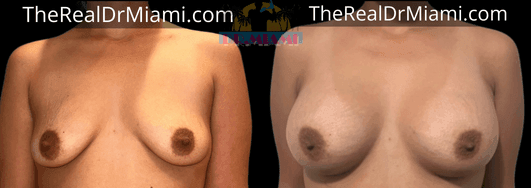 Before-and-after views for Breast Lift, Case 7.