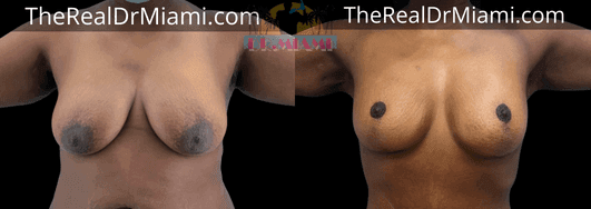 Before-and-after views for Breast Lift, Case 103.