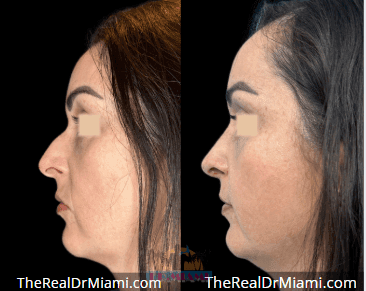 Before-and-after views for Rhinoplasty, Case 122.
