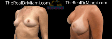 Before-and-after views for Breast Augmentation, Case 88.