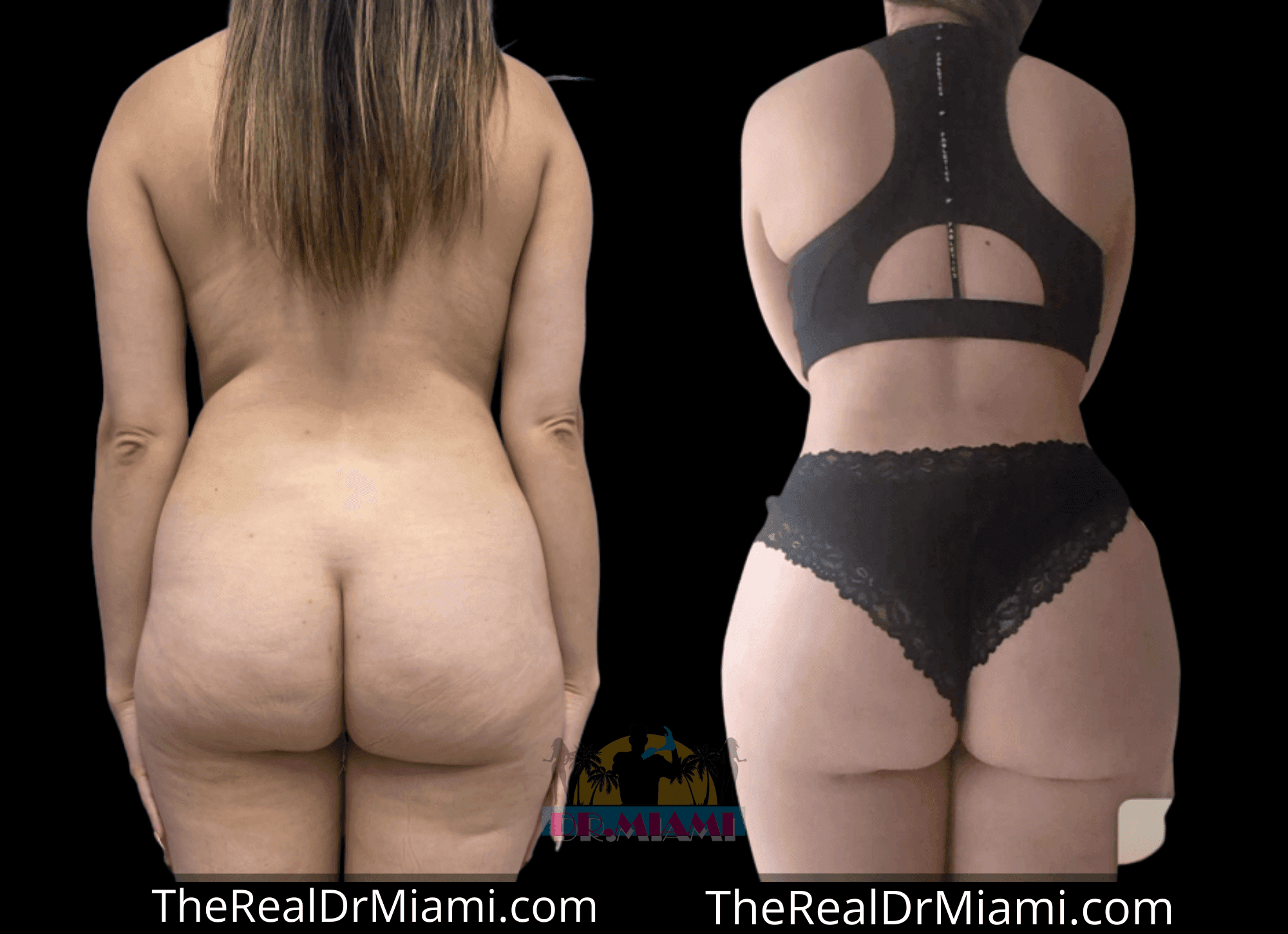 Before-and-after views for Brazilian Butt Lift, Case 123.