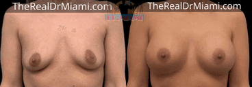 Before-and-after views for Breast Augmentation, Case 67.