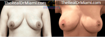Before-and-after views for Breast Augmentation, Case 46.