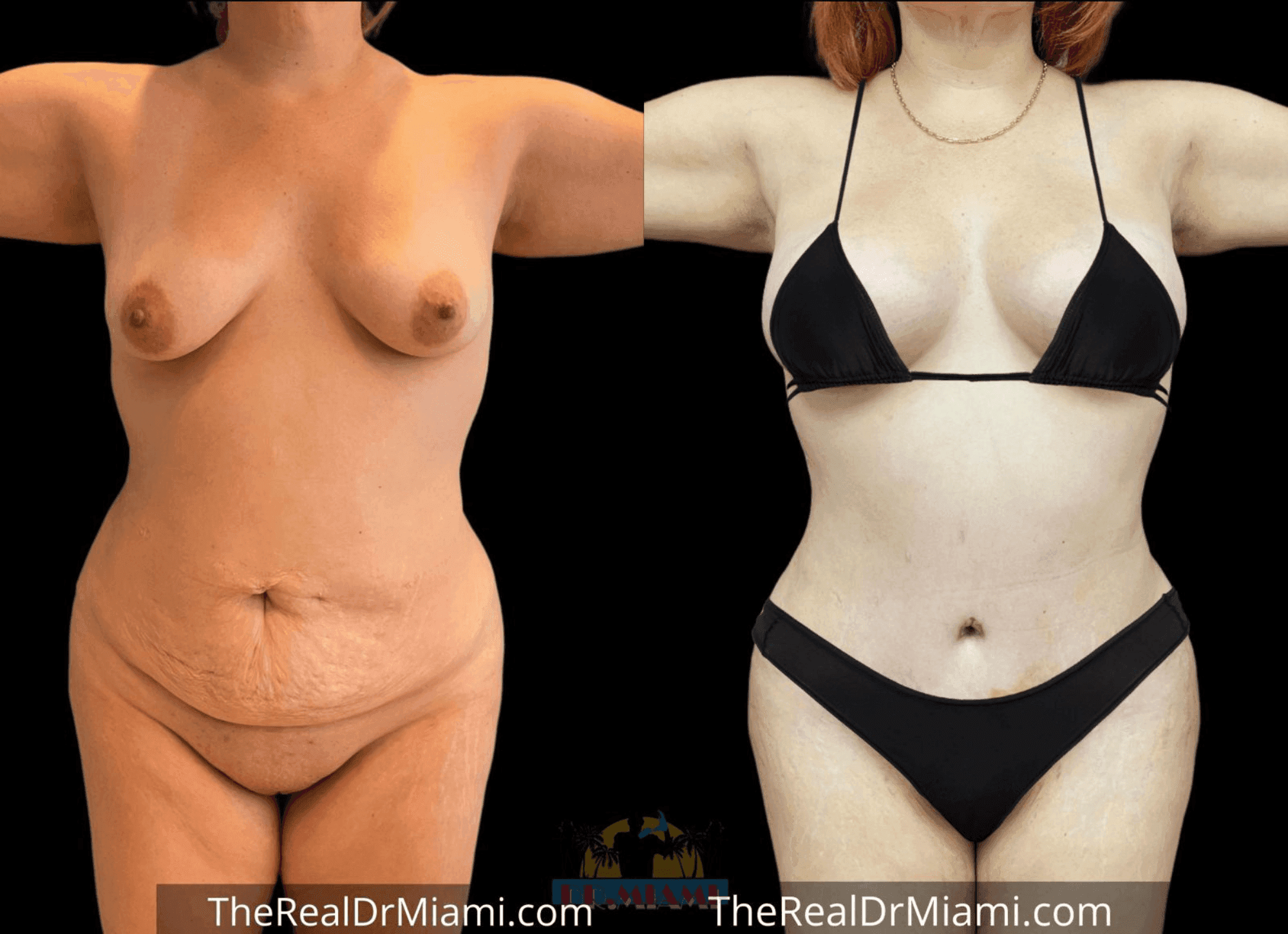 Before-and-after views for Mommy Makeover, Case 20.