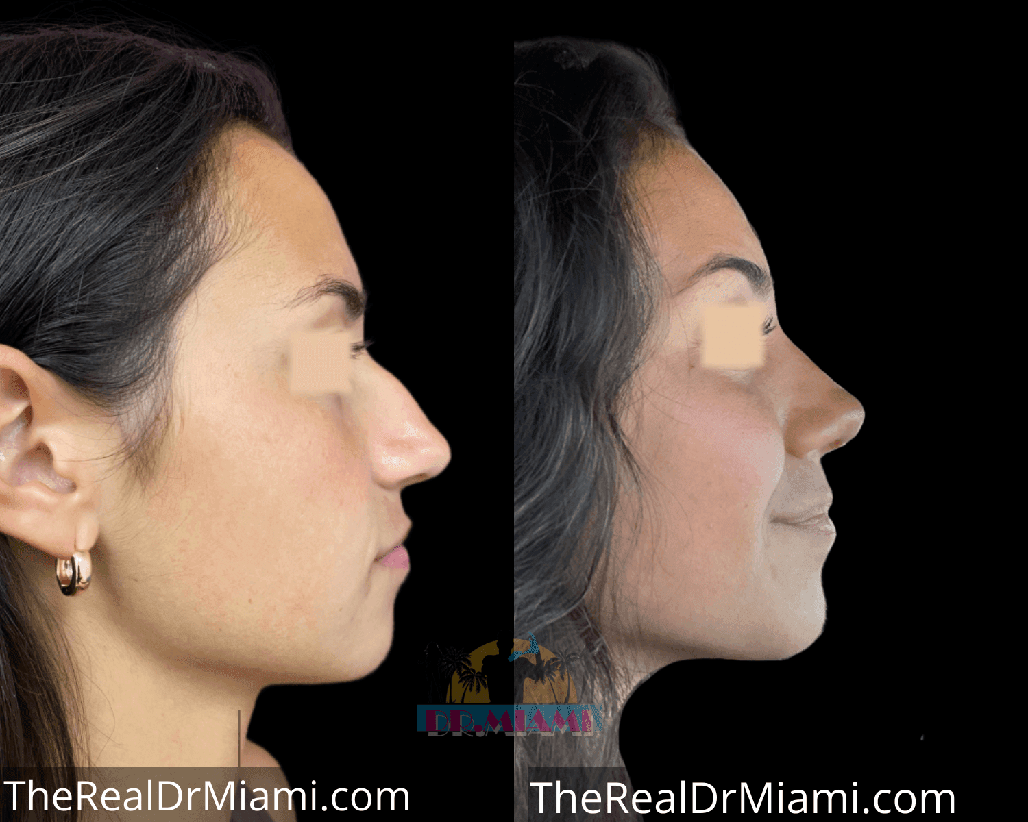 Before-and-after views for Rhinoplasty, Case 55.