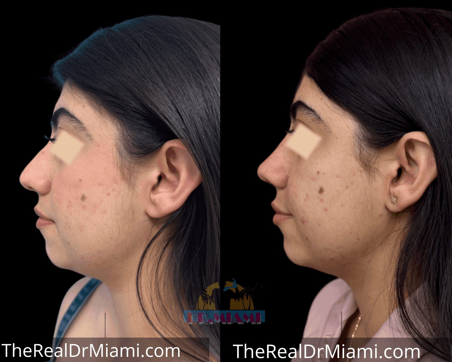 Before-and-after views for Rhinoplasty, Case 7.