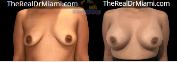Before-and-after views for Breast Augmentation, Case 32.