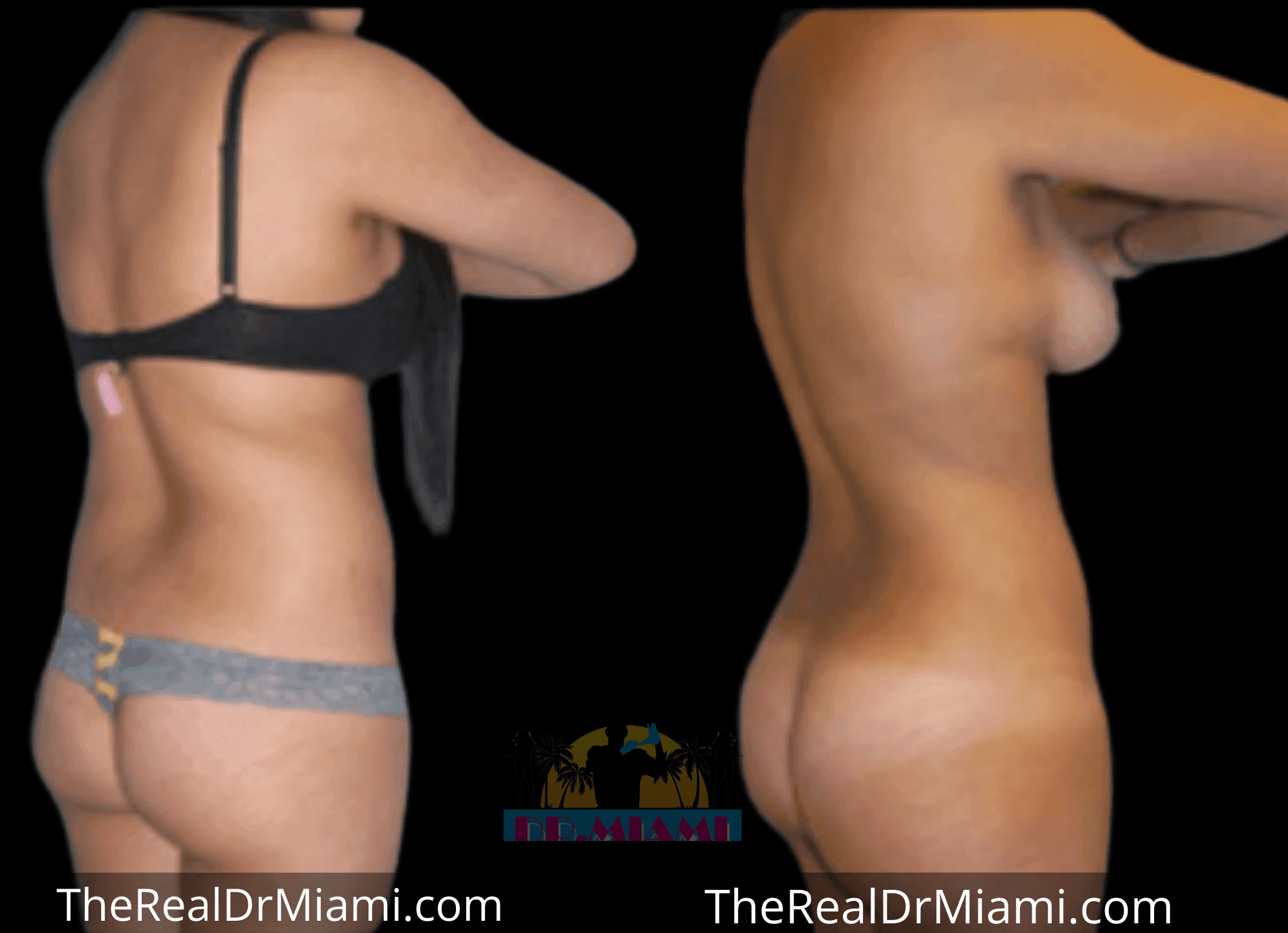 Before-and-after views for Brazilian Butt Lift, Case 53.