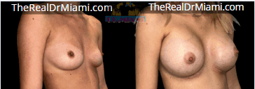 Before-and-after views for Breast Augmentation, Case 42.