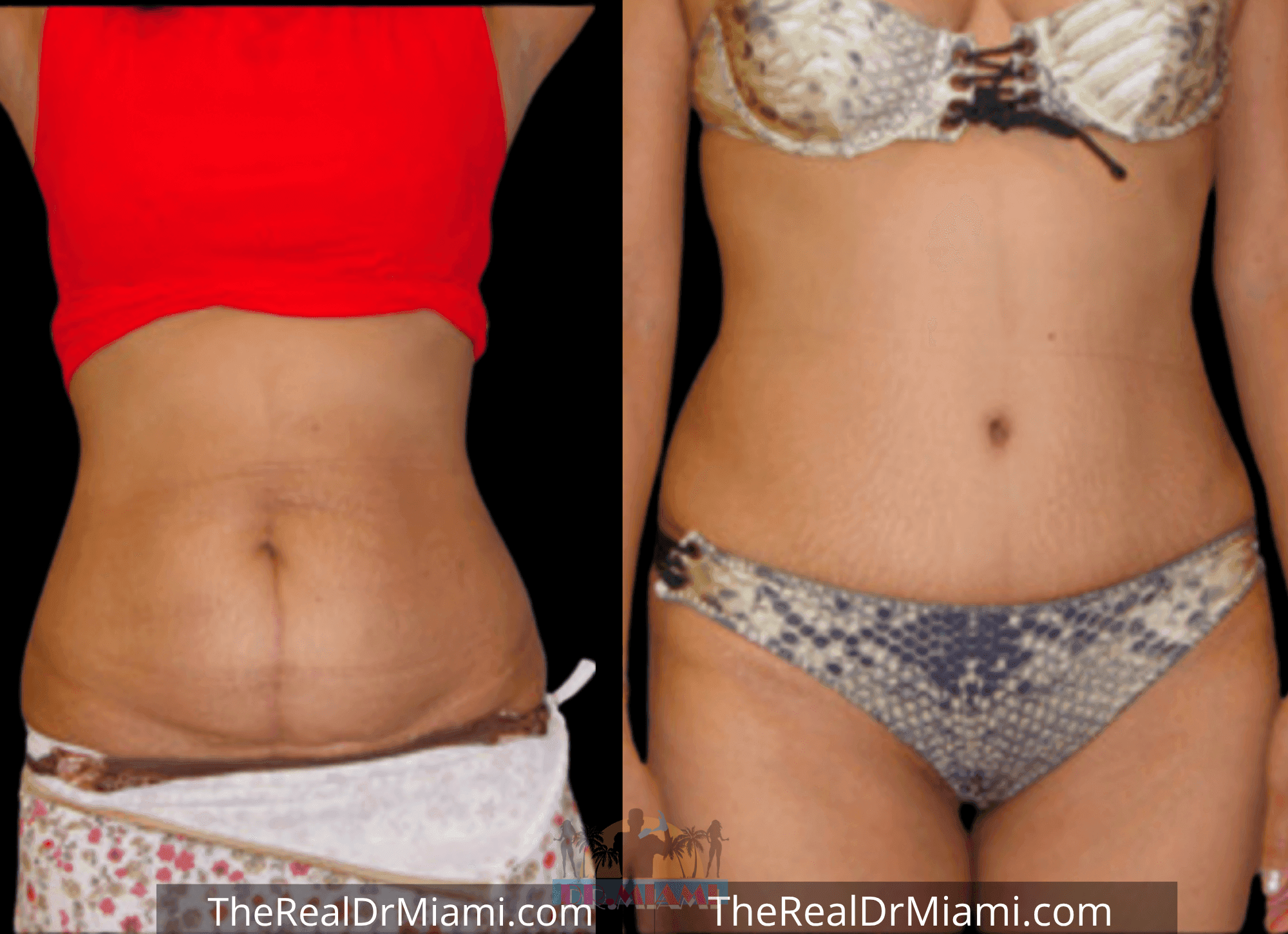 Before-and-after views for Tummy Tuck, Case 78.