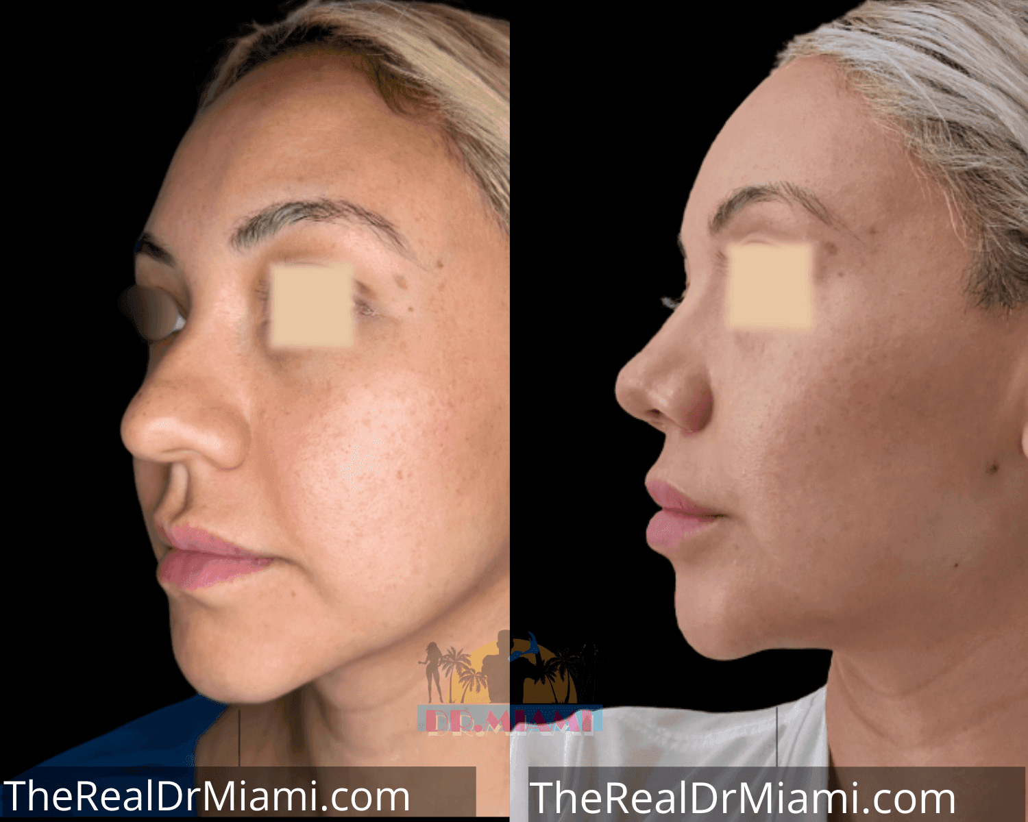 Before-and-after views for Rhinoplasty, Case 40.