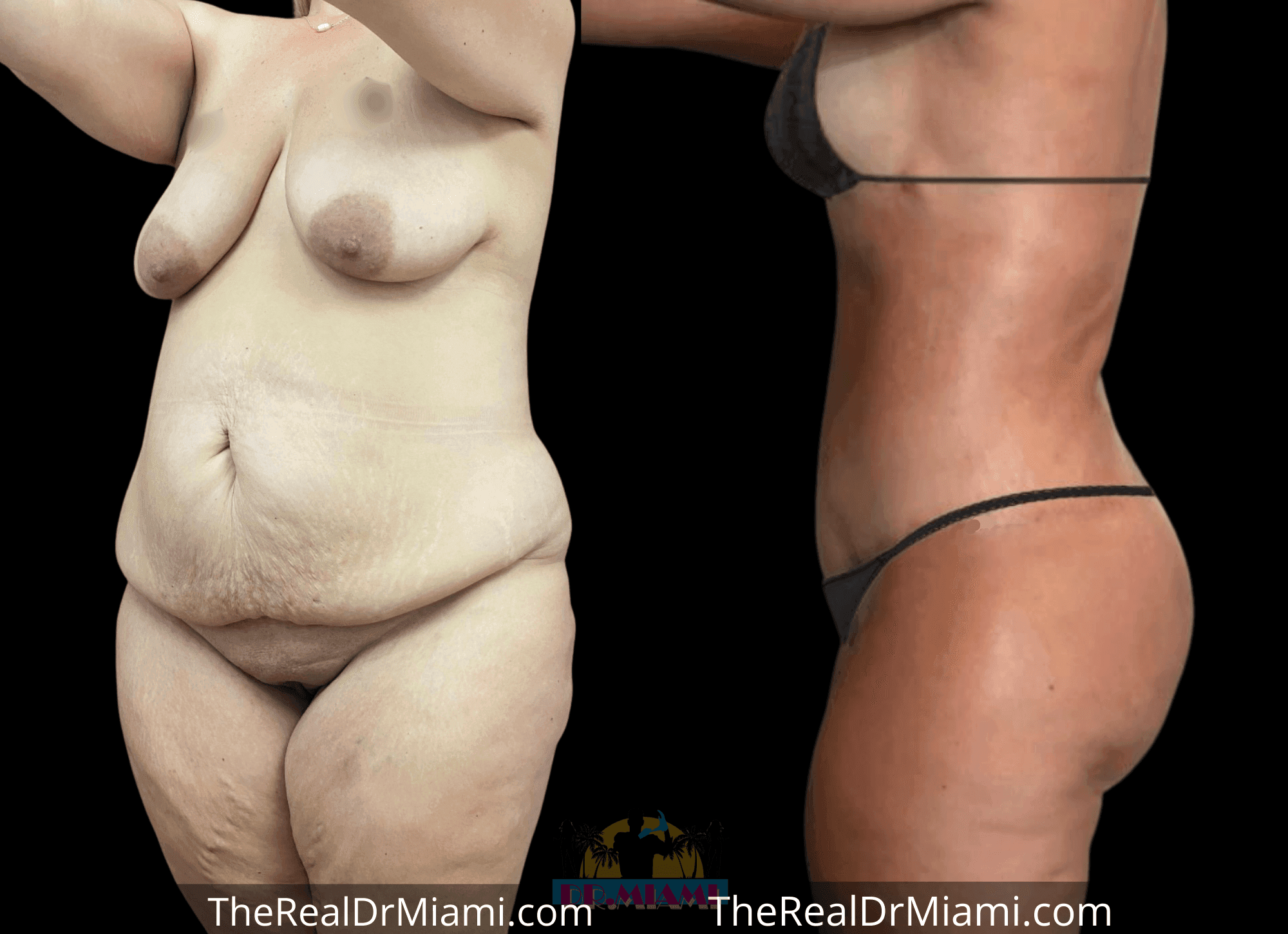 Before-and-after views for Mommy Makeover, Case 108.