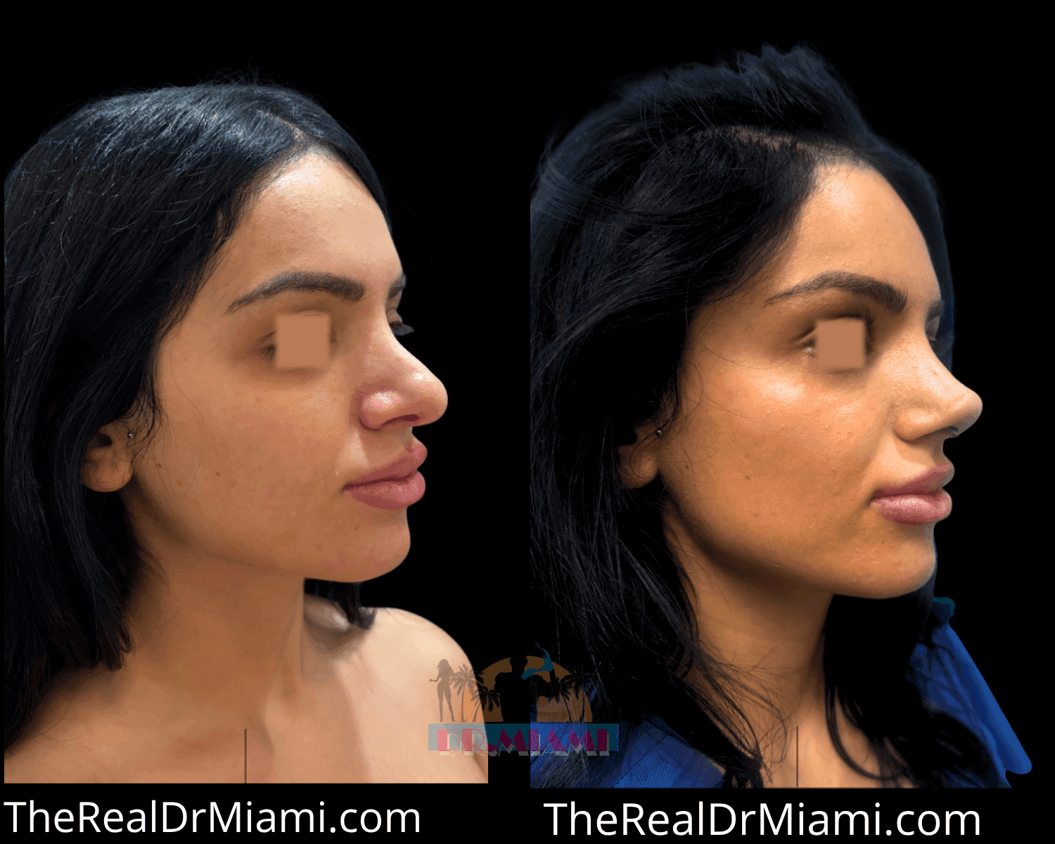 Before-and-after views for Rhinoplasty, Case 135 — Additional result.