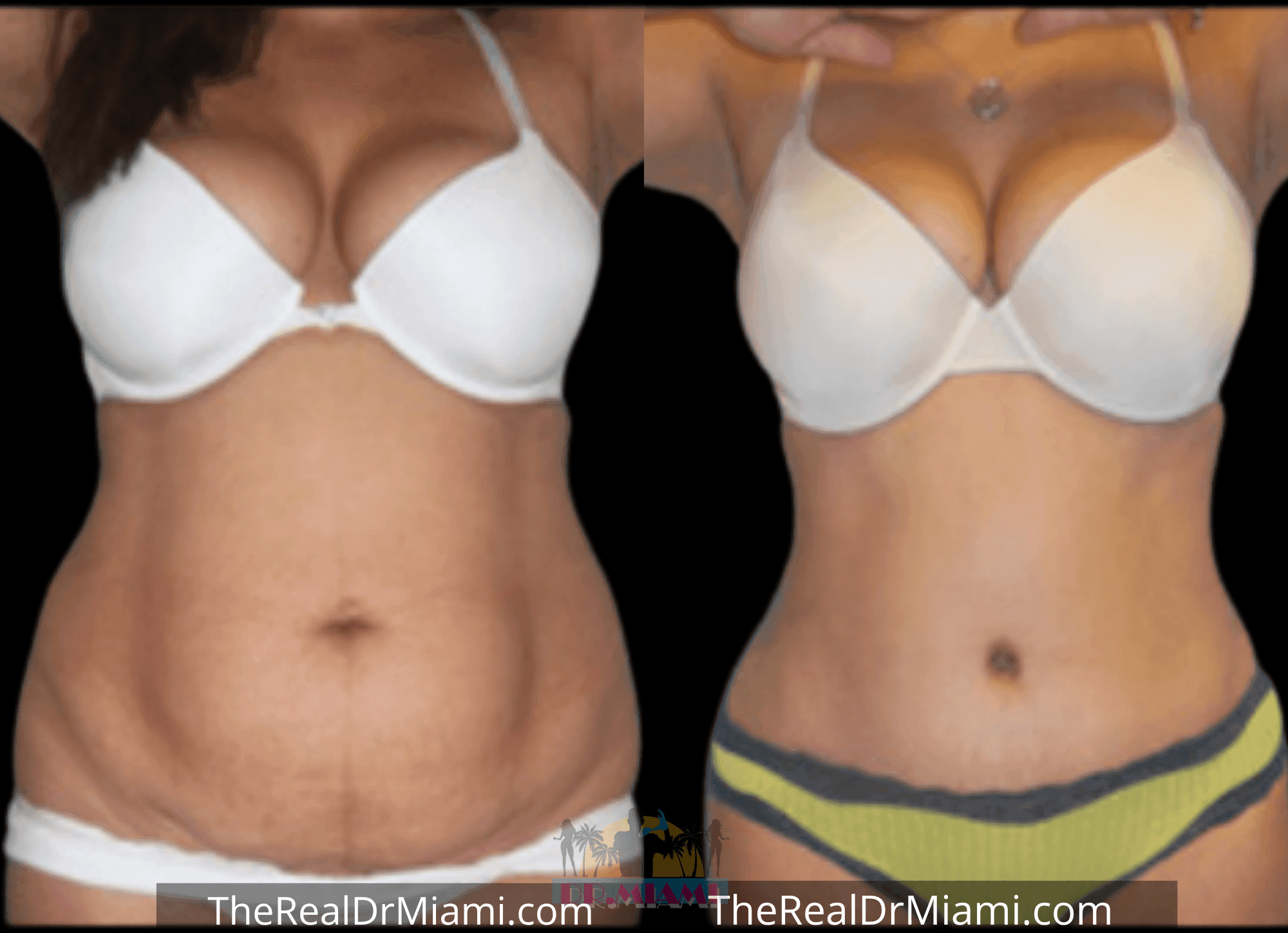Before-and-after views for Tummy Tuck, Case 87.