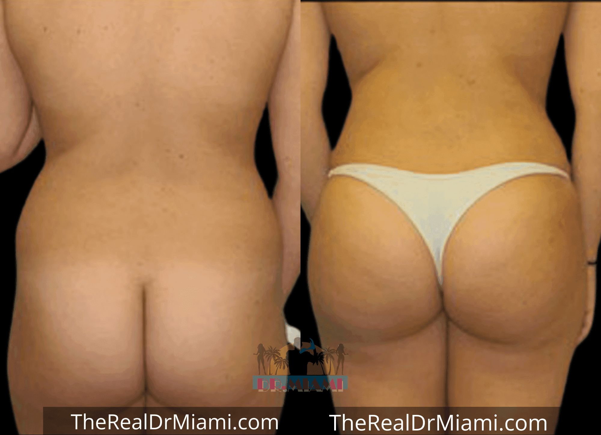 Before-and-after views for Brazilian Butt Lift, Case 89.