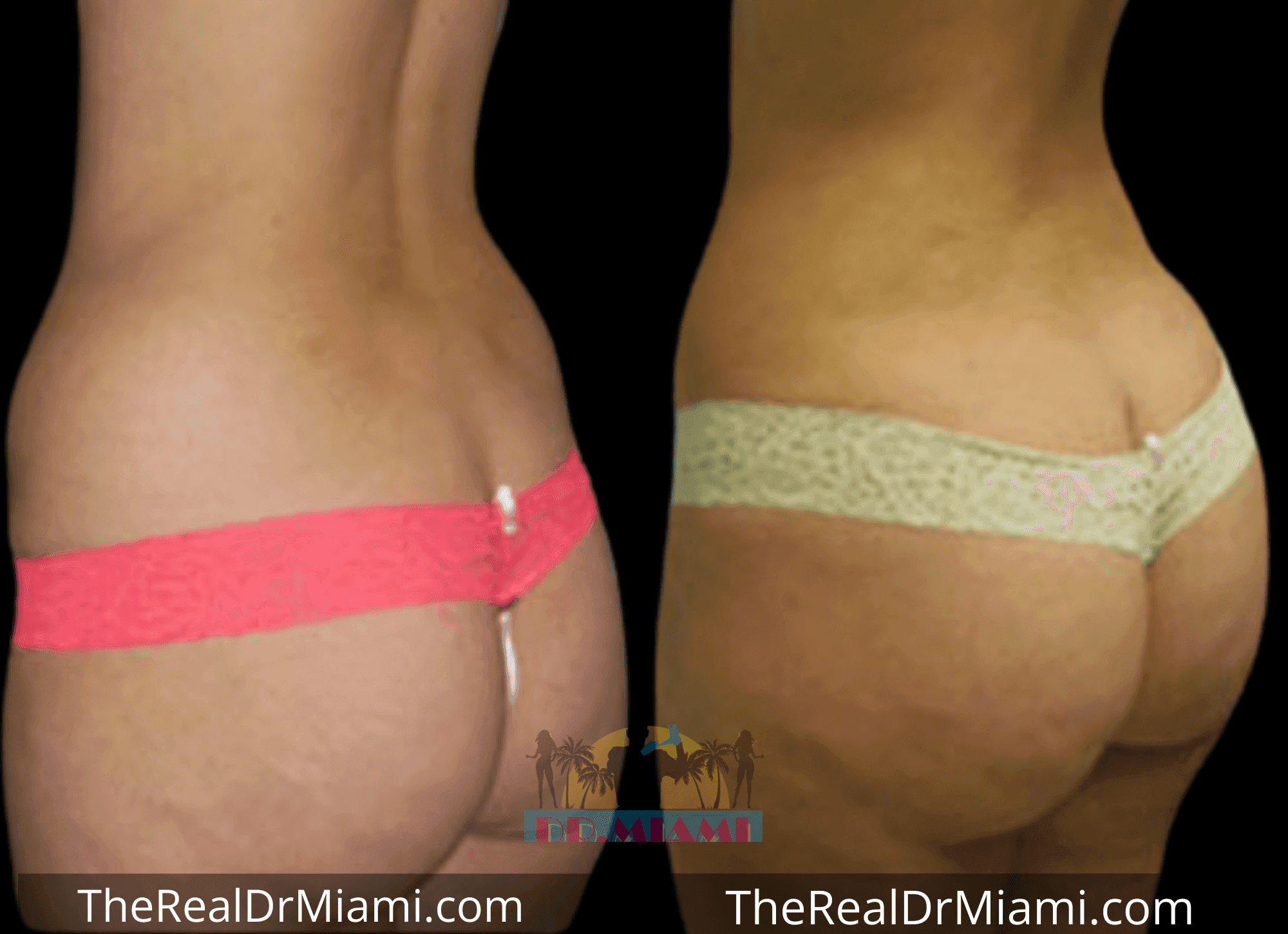 Before-and-after views for Brazilian Butt Lift, Case 36.