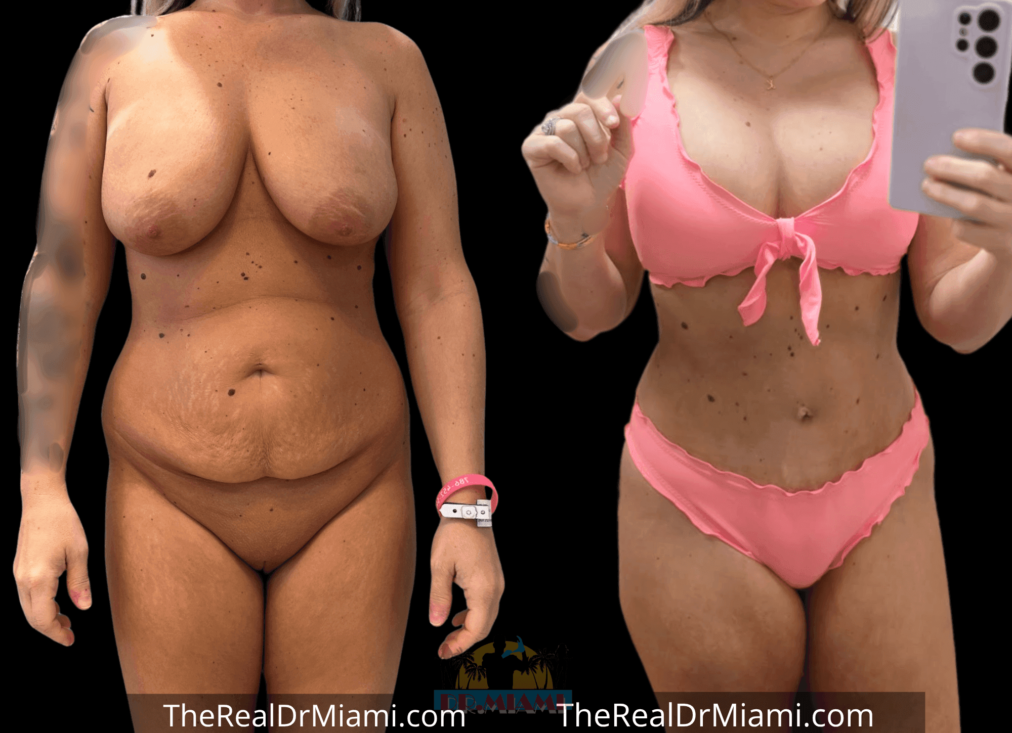 Before-and-after views for Mommy Makeover, Case 98.