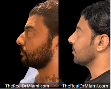 Before-and-after views for Rhinoplasty, Case 119.