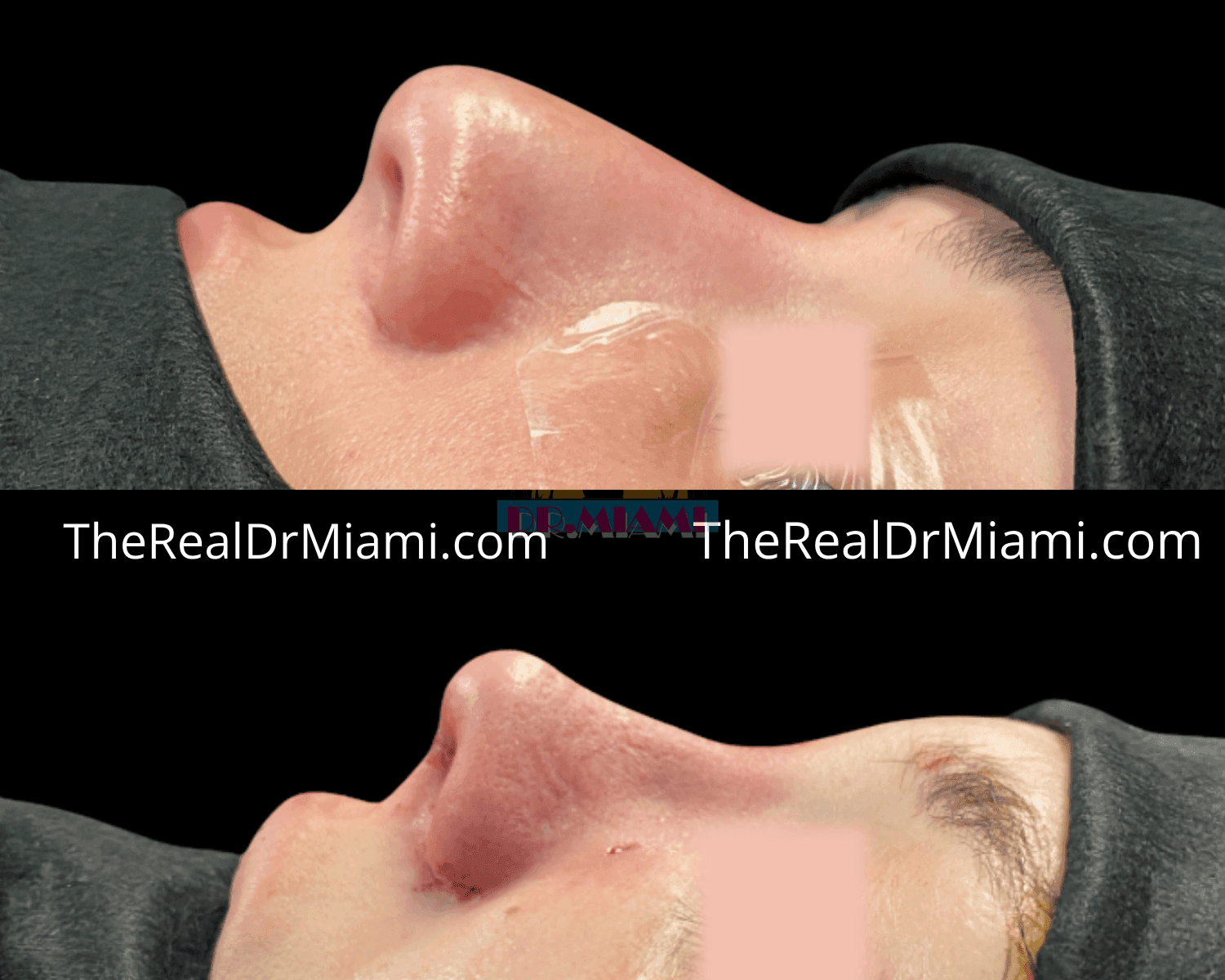 Before-and-after views for Rhinoplasty, Case 3.