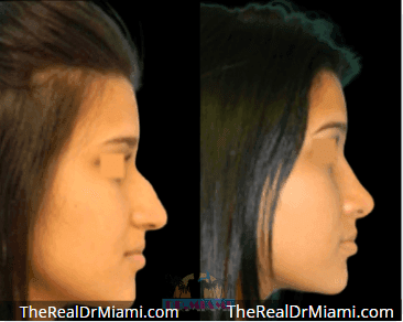 Before-and-after views for Rhinoplasty, Case 123.