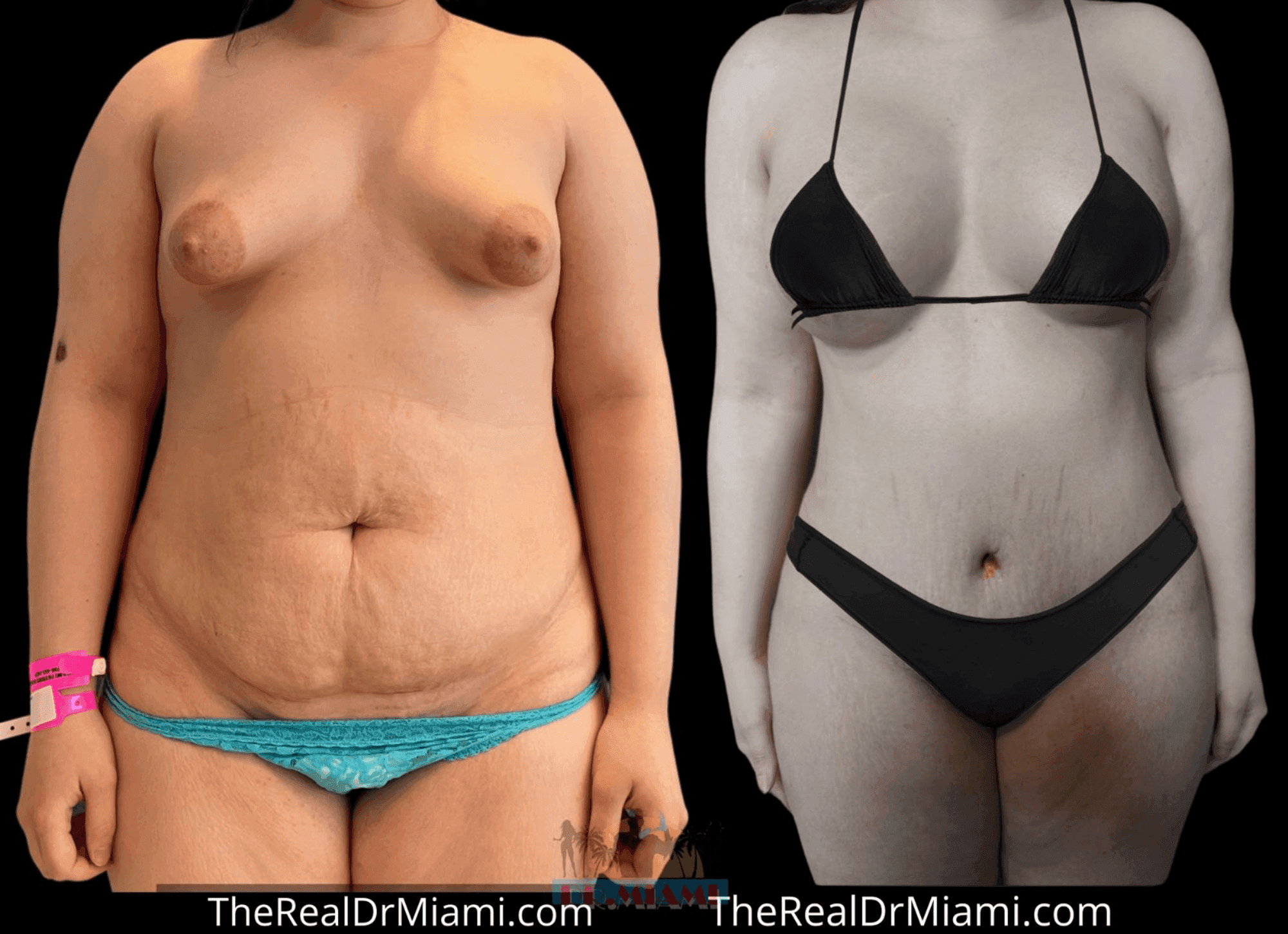 Before-and-after views for Mommy Makeover, Case 14.