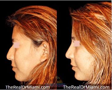 Before-and-after views for Rhinoplasty, Case 96.