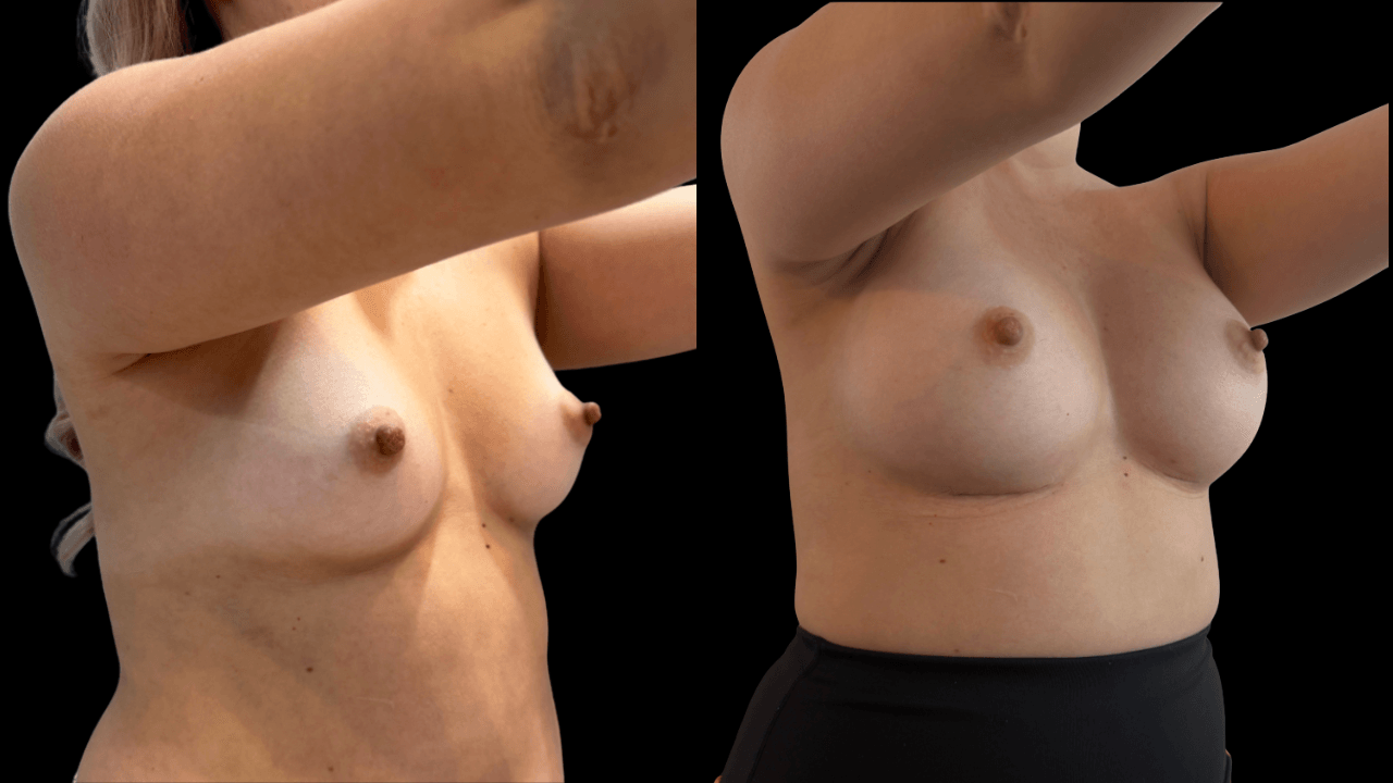 Before-and-after views for Breast Augmentation / Lift, Case 10 from The Next Dr. Miami collection.