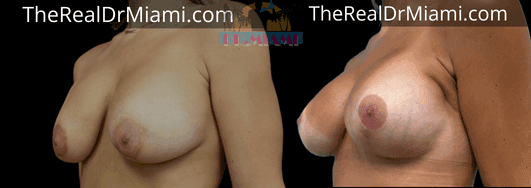 Before-and-after views for Breast Lift, Case 70.