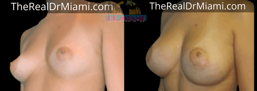 Before-and-after views for Breast Lift, Case 30.