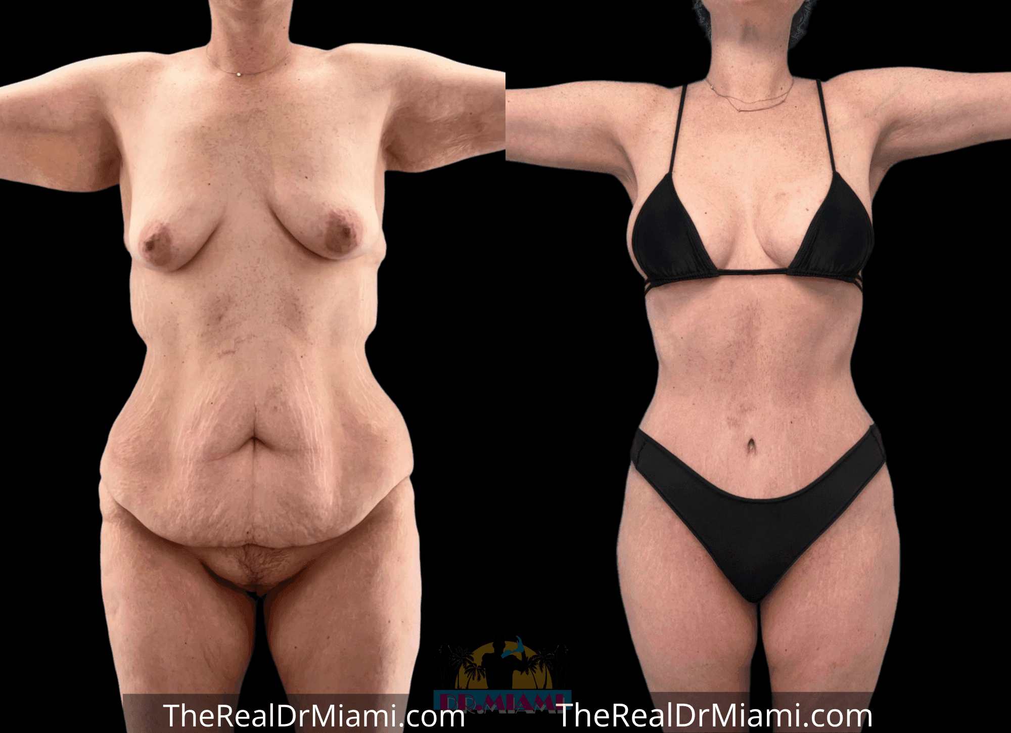 Before-and-after views for Tummy Tuck, Case 98.