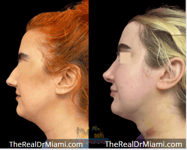 Before-and-after views for Rhinoplasty, Case 118.