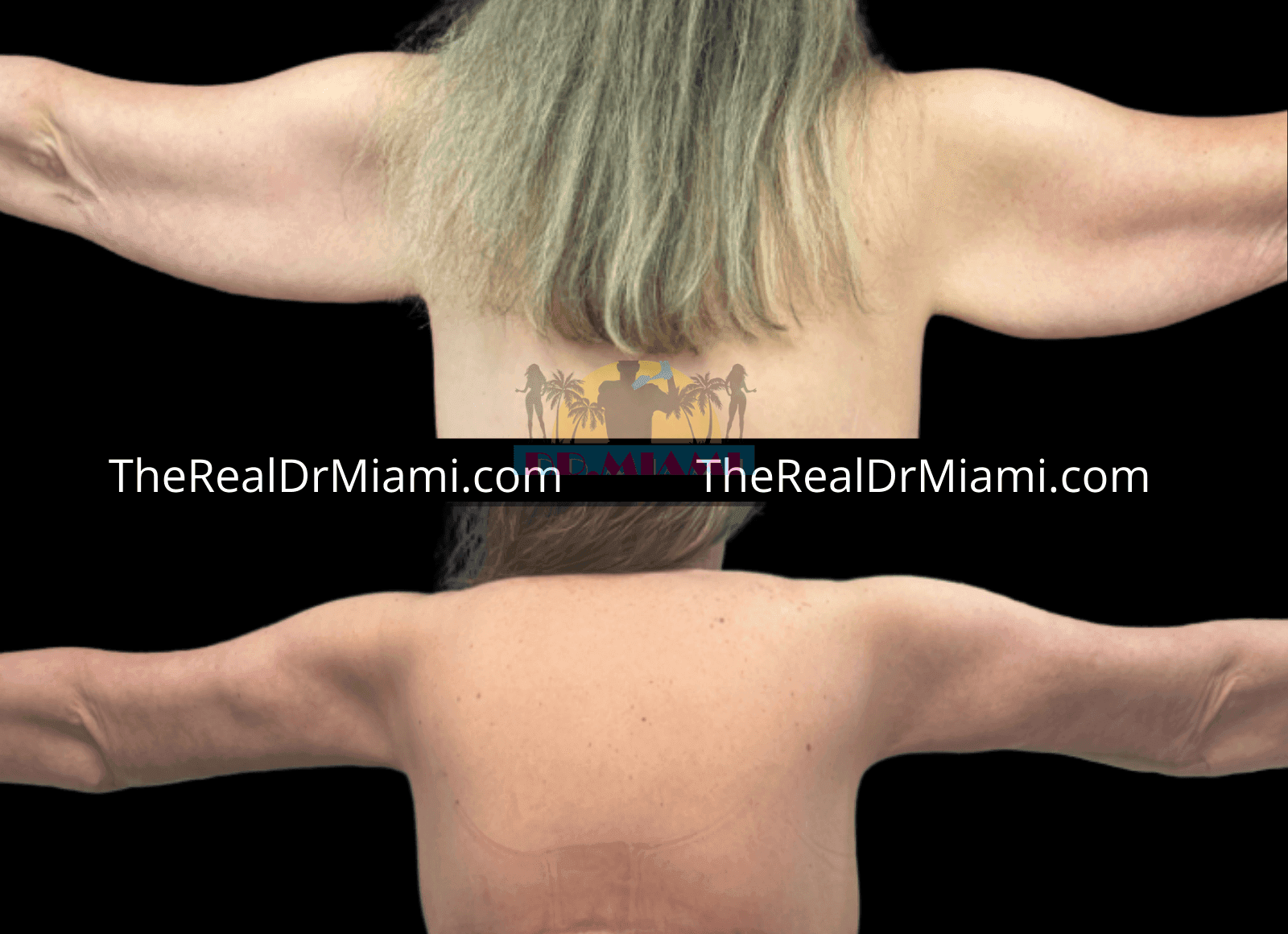 Before-and-after views for Upper Arm Lift, Case 7.