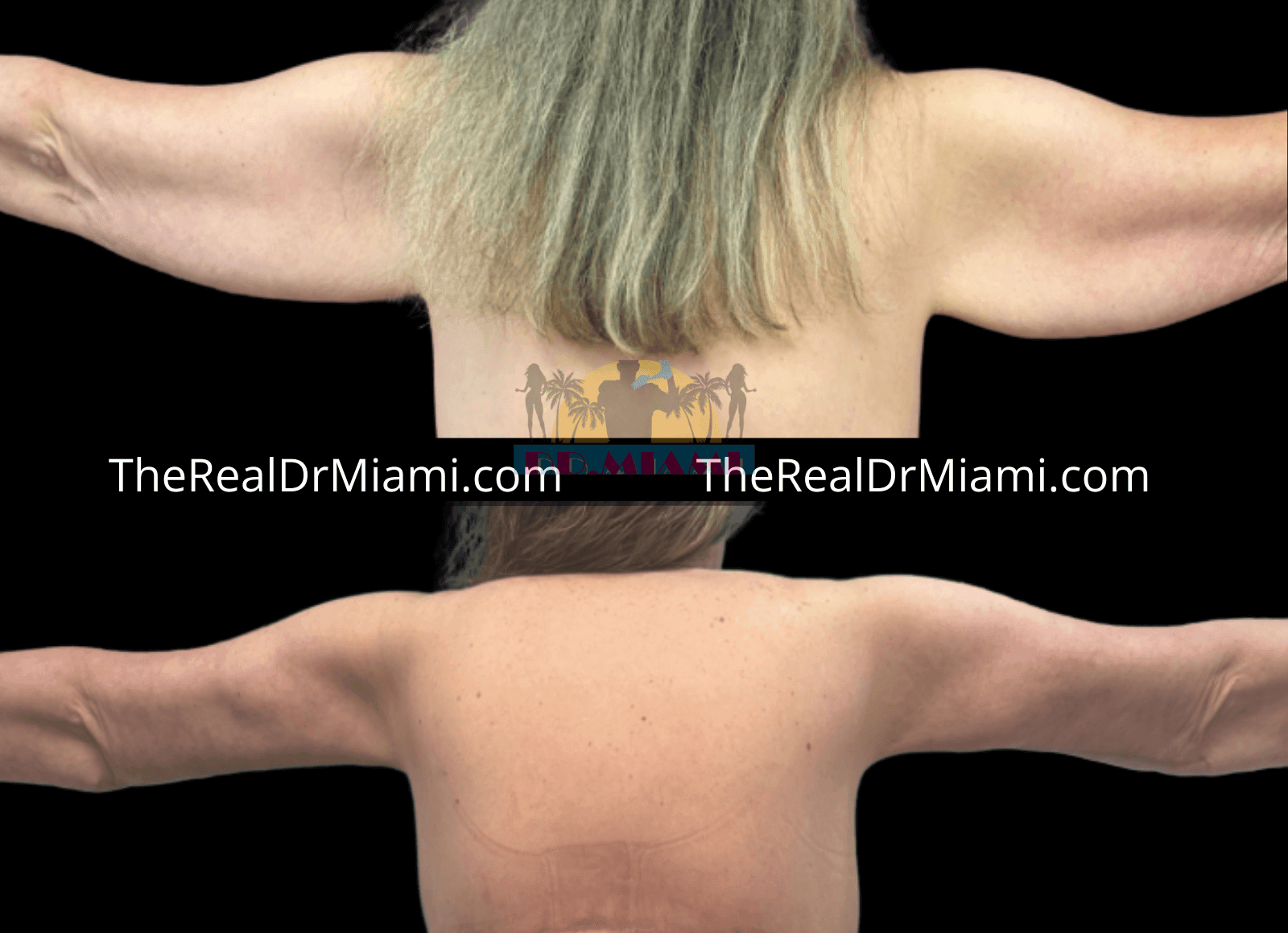 Before-and-after views for Upper Arm Lift, Case 7.