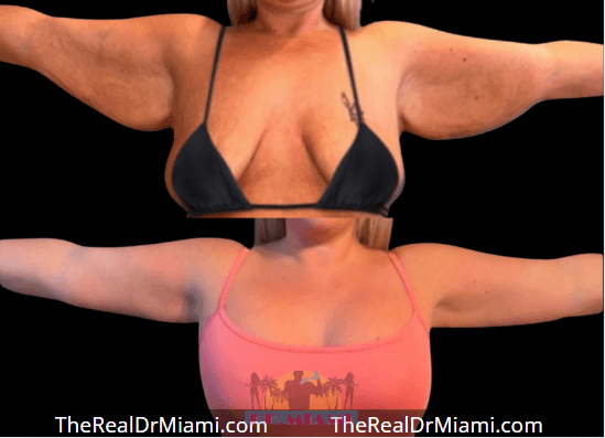 Before-and-after views for Upper Arm Lift, Case 15.
