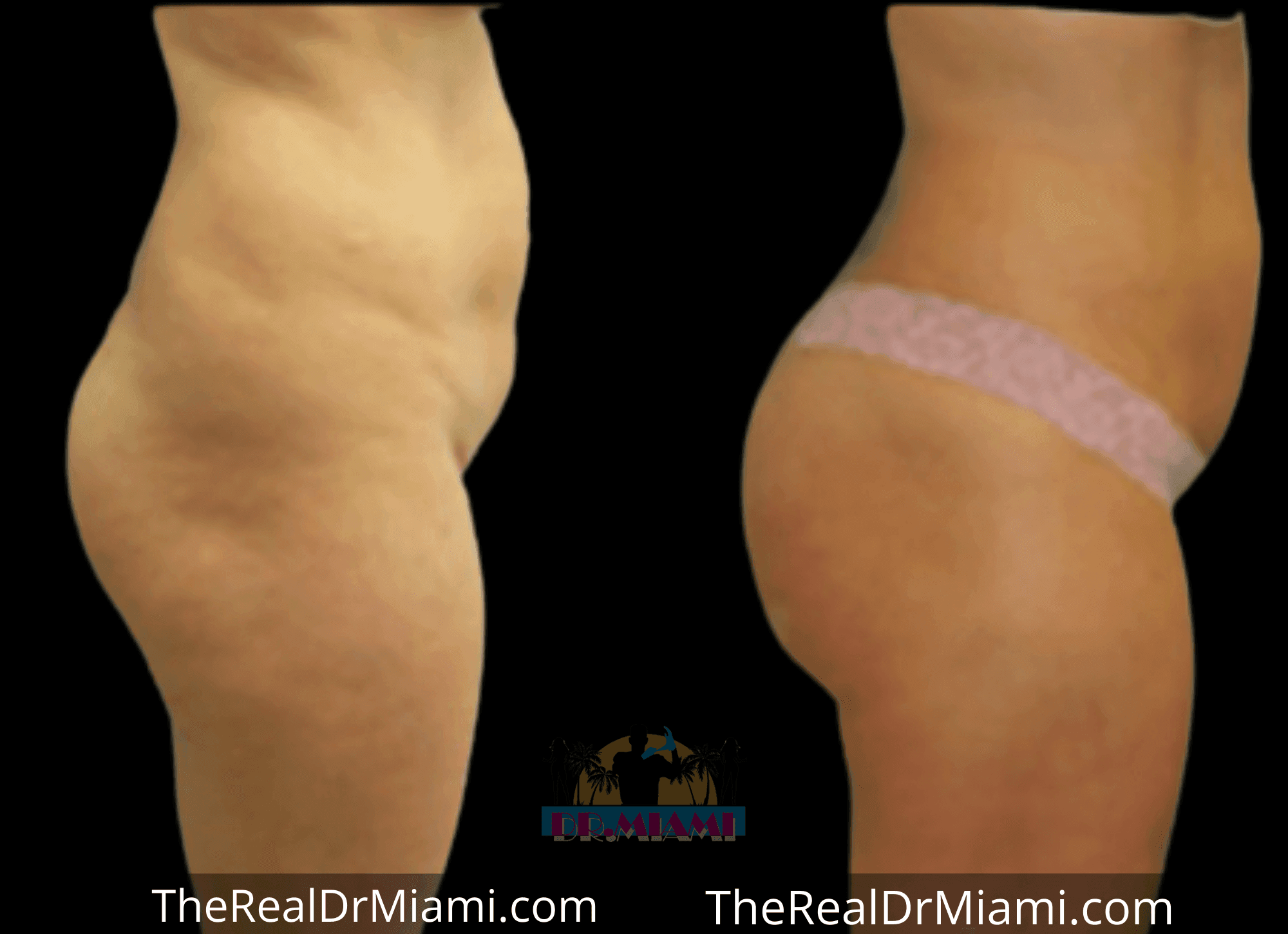 Before-and-after views for Brazilian Butt Lift, Case 42.