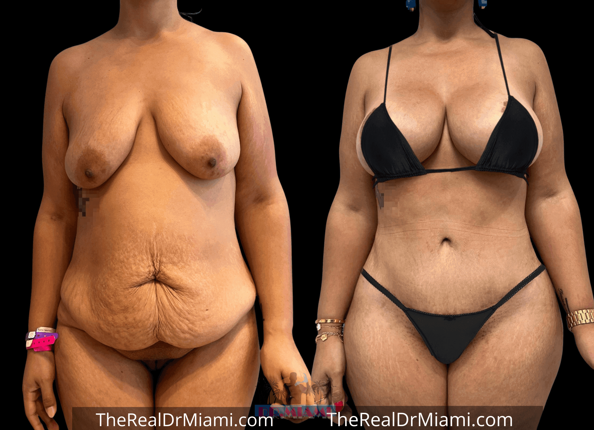 Before-and-after views for Mommy Makeover, Case 113.