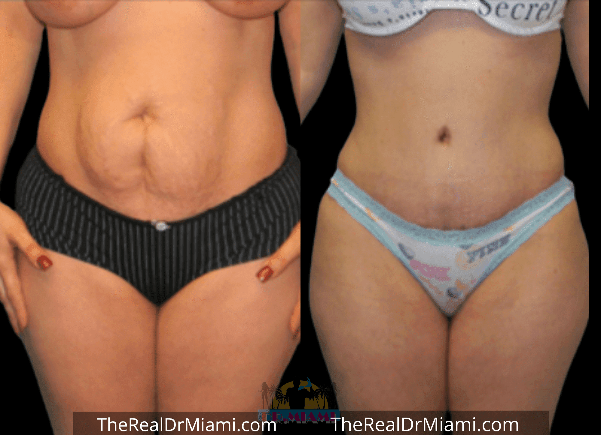 Before-and-after views for Tummy Tuck, Case 60.