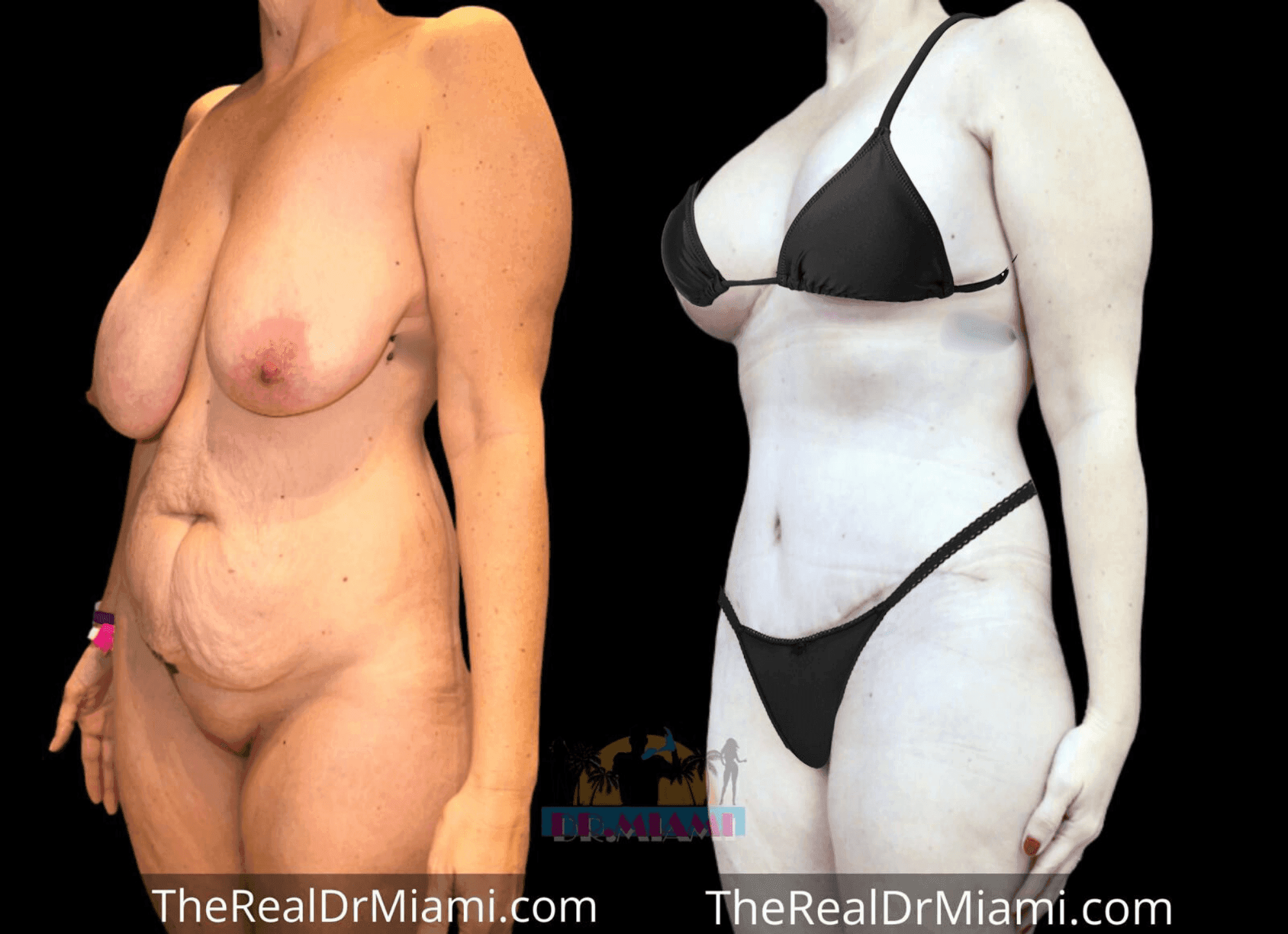 Before-and-after views for Mommy Makeover, Case 45.