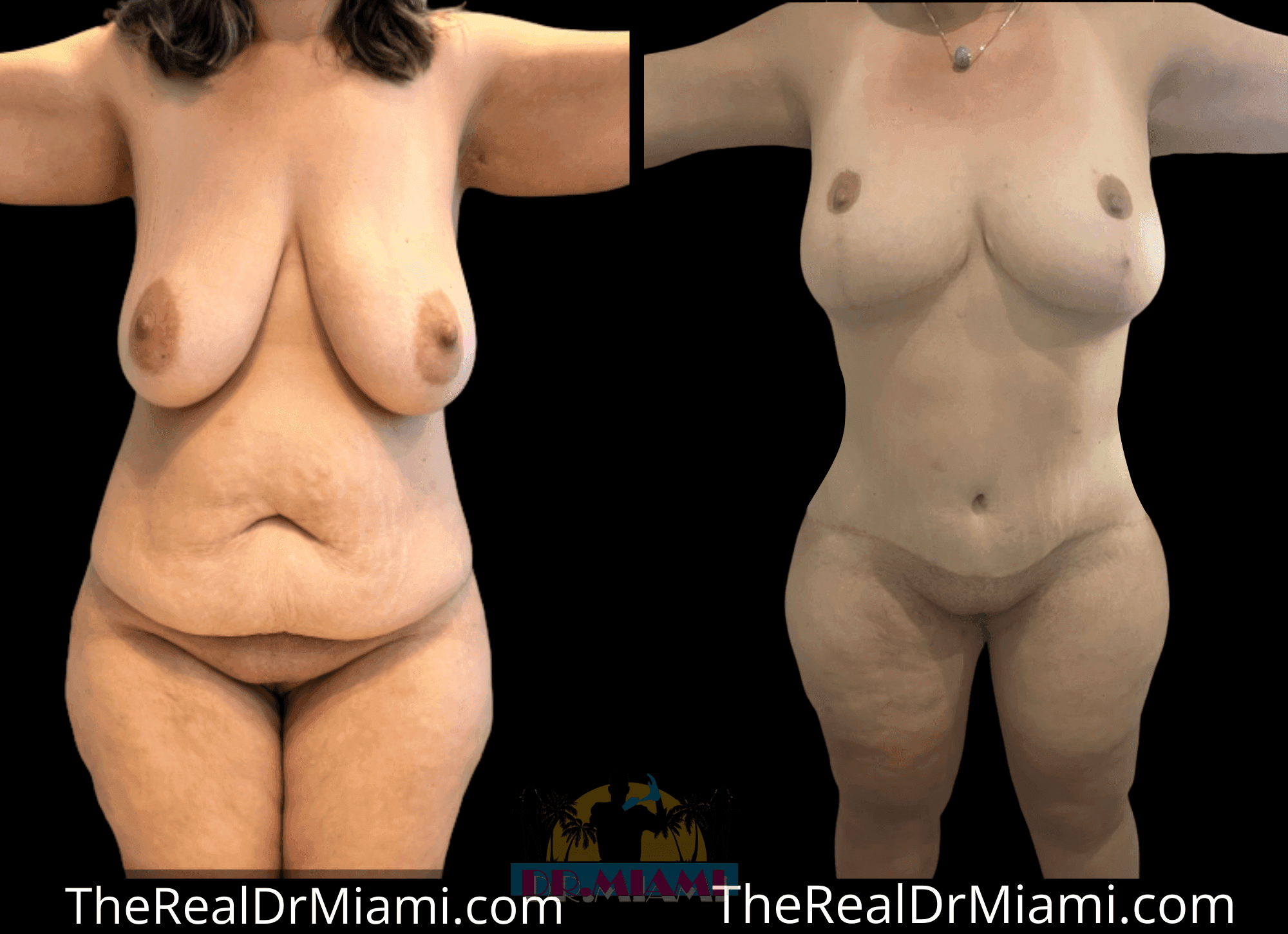 Before-and-after views for Massive Weight Loss, Case 41.
