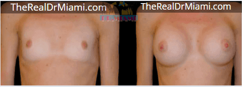 Before-and-after views for Breast Augmentation, Case 120.