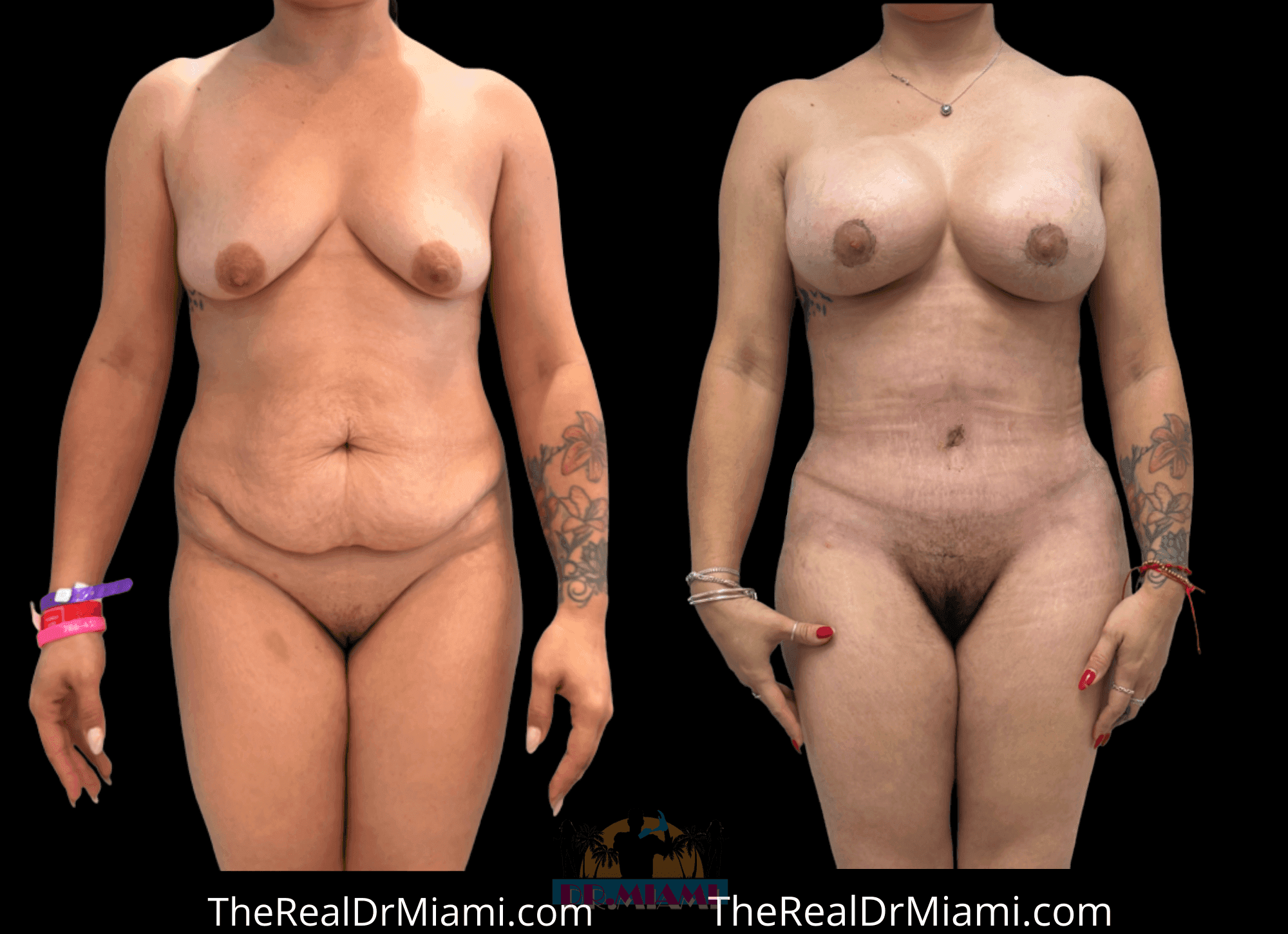 Before-and-after views for Mommy Makeover, Case 109.