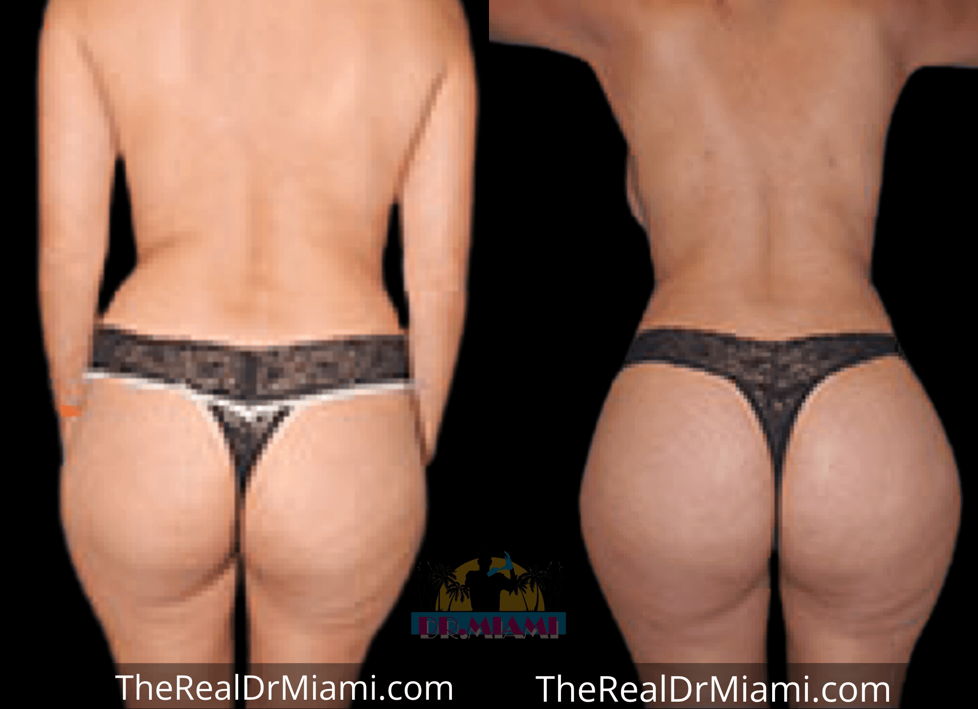 Before-and-after views for Brazilian Butt Lift, Case 7.