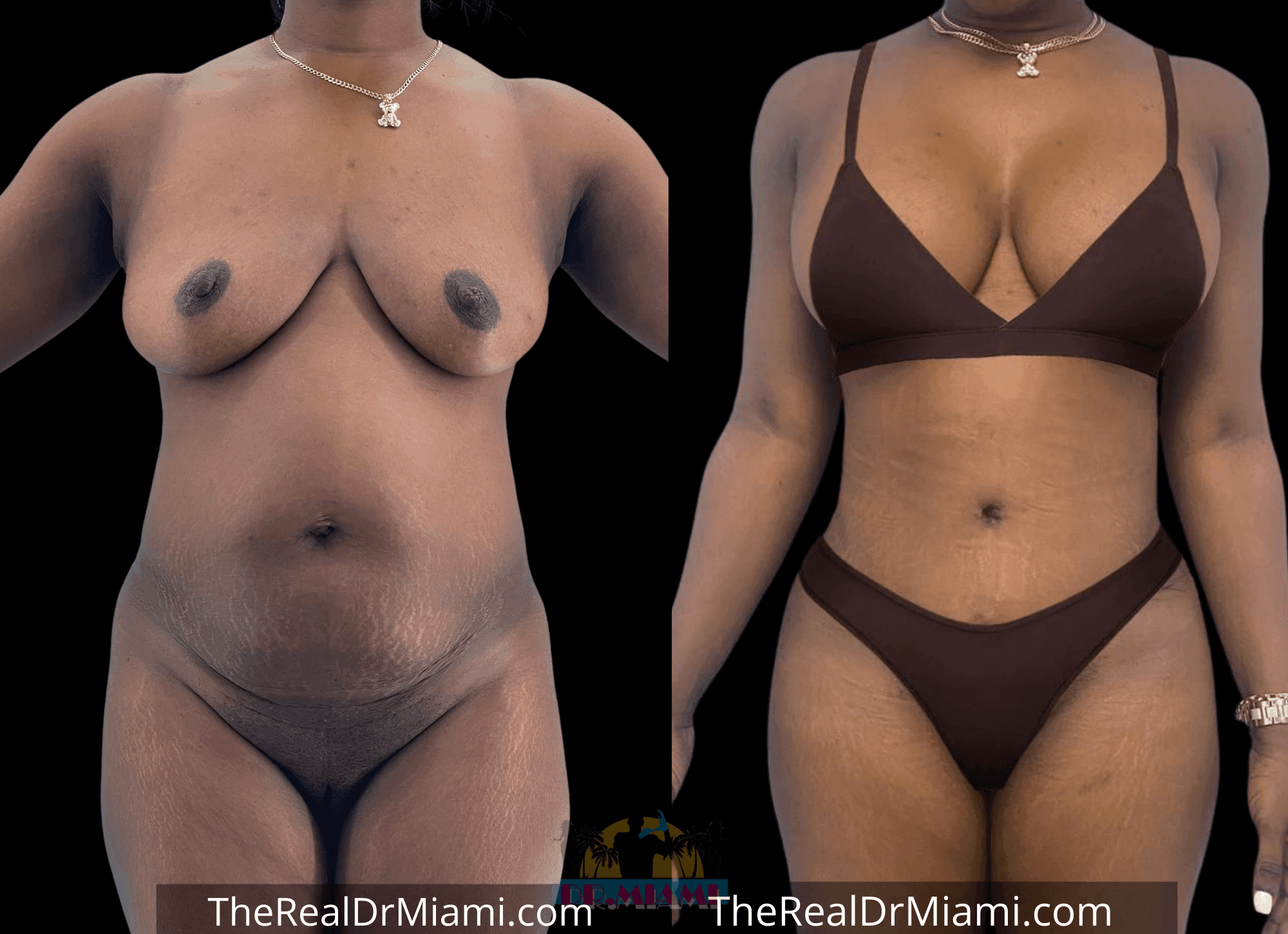 Before-and-after views for Mommy Makeover, Case 84.