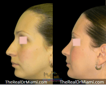 Before-and-after views for Rhinoplasty, Case 78.