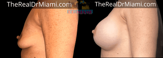 Before-and-after views for Breast Lift, Case 69.