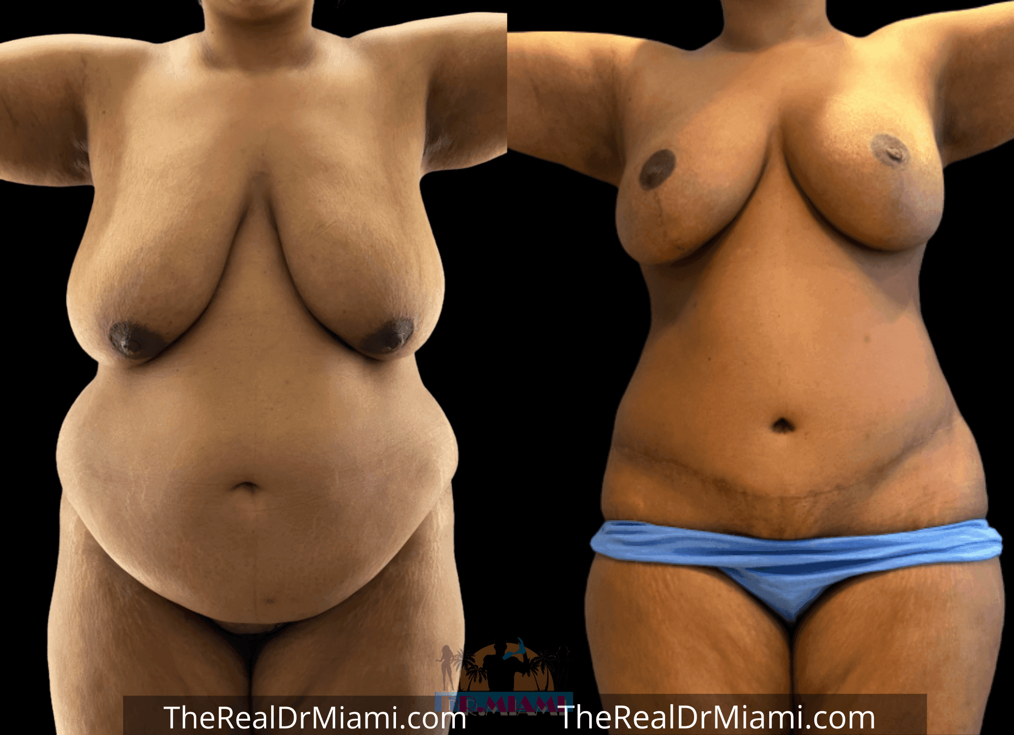 Before-and-after views for Mommy Makeover, Case 65.