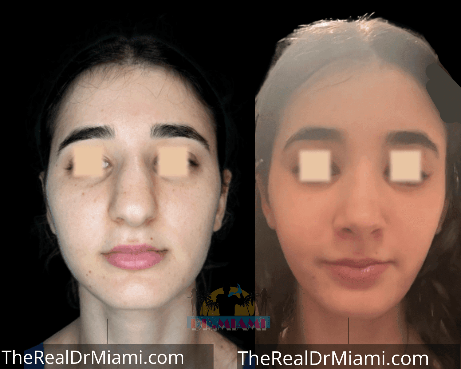 Before-and-after views for Rhinoplasty, Case 23.